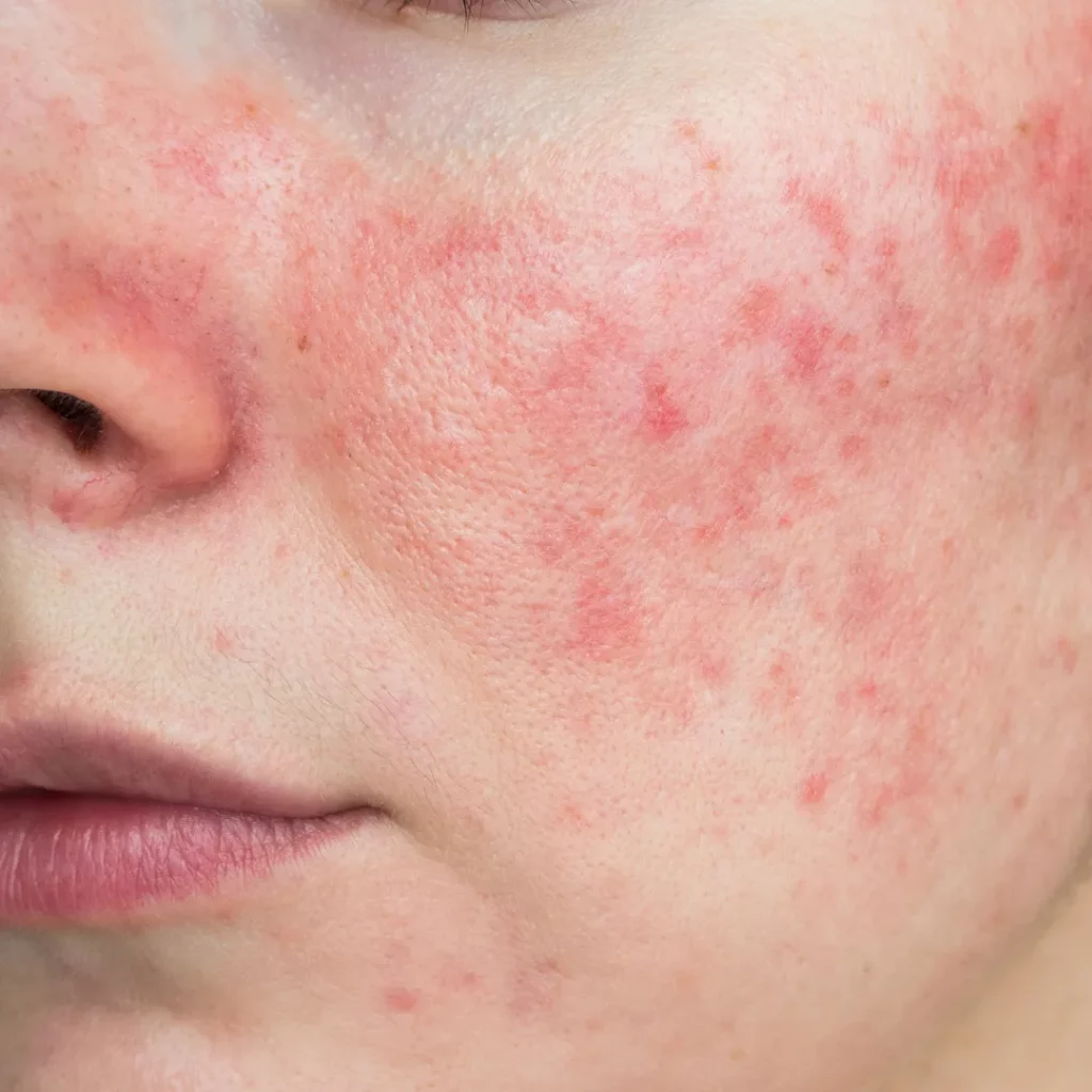 rosacea