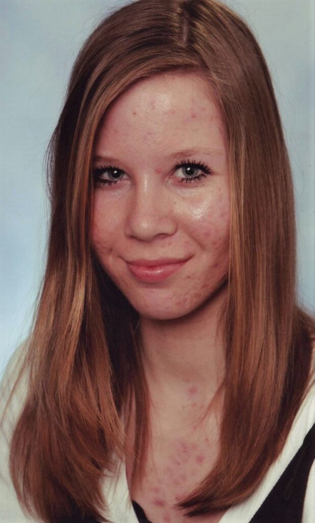 mijn acne