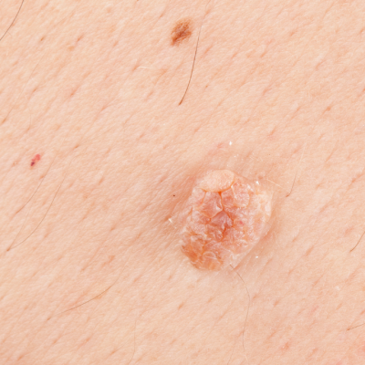 ouderdomswratten fibromen