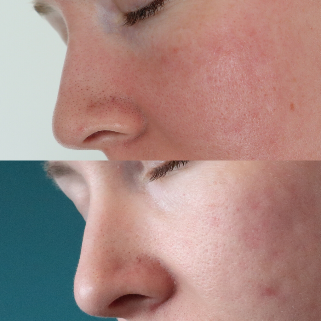 resultaat peeling