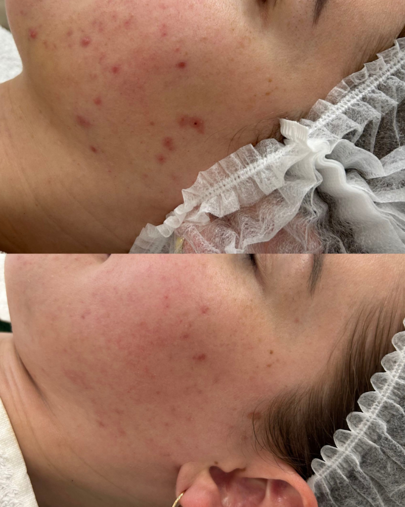 Resultaat acne