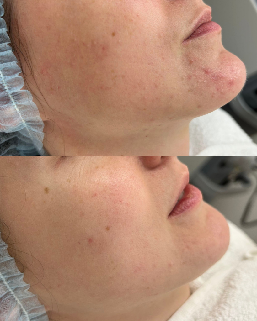 Resultaat acne