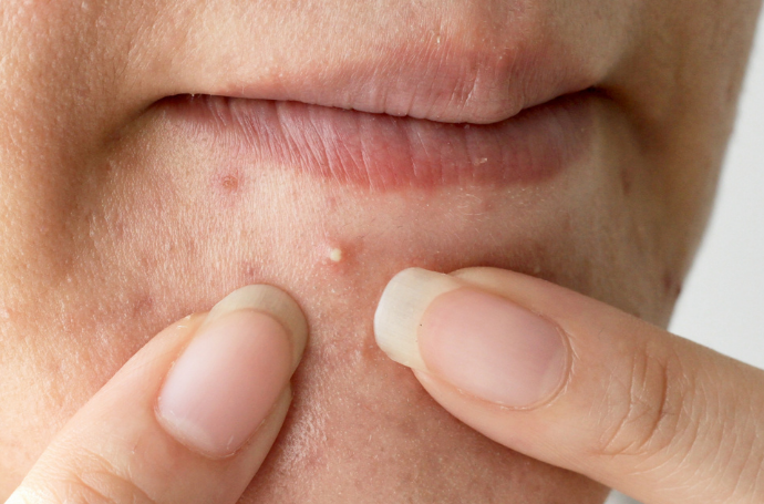 Misverstanden acne
