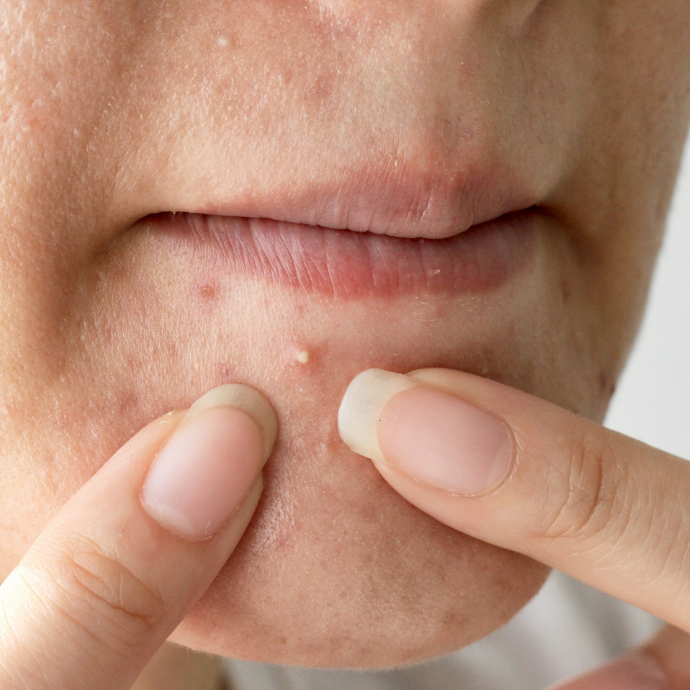 Misverstanden acne
