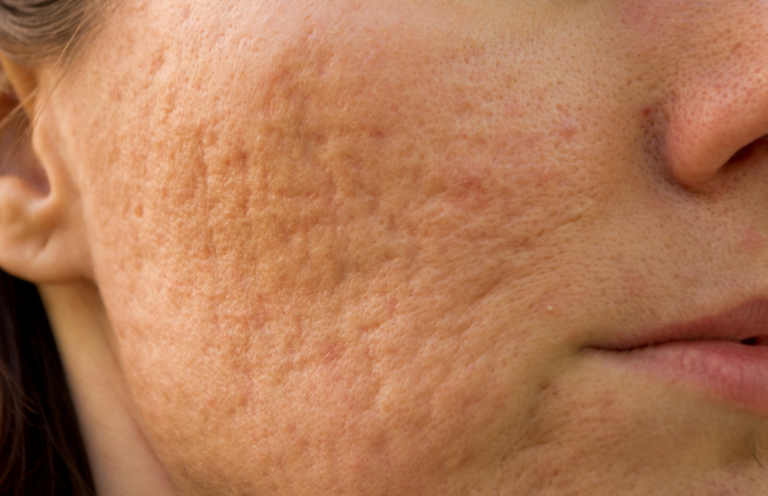 Acne littekens