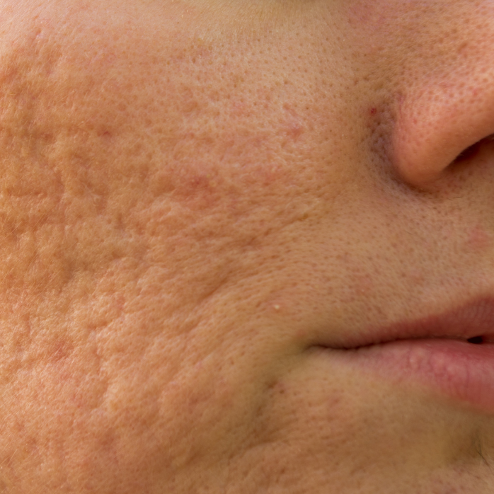 Acne littekens