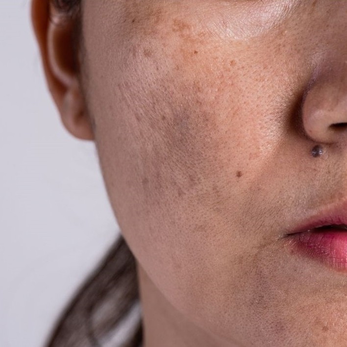 melasma