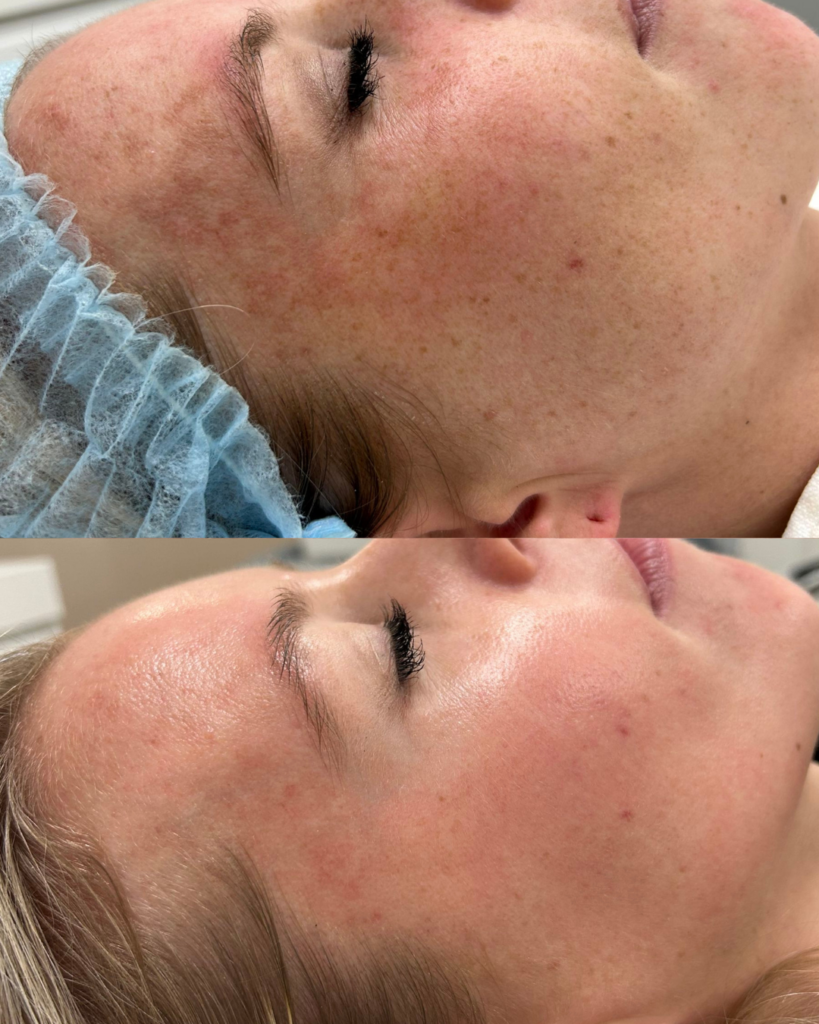 resultaat melasma