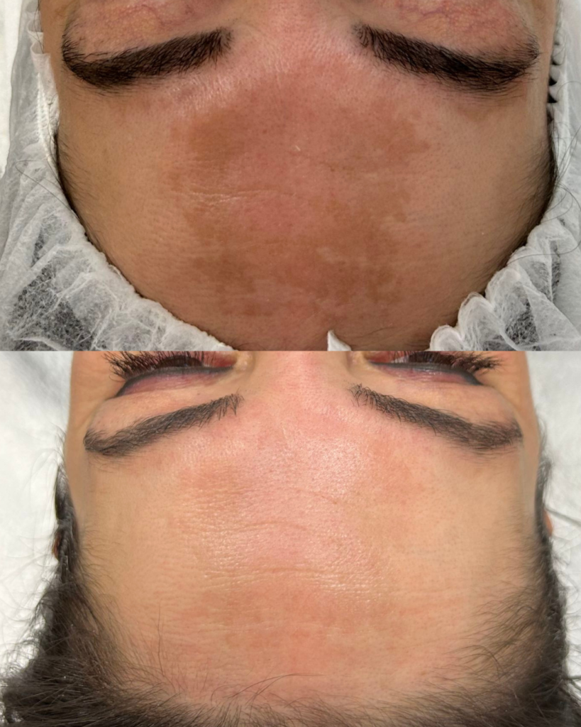 resultaat melasma